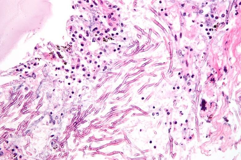 Pilze verändern das Immunsystem und verursachen die Bildung von Mykosen.